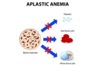 Ilustrasi penyakit anemia aplastik (kompas)